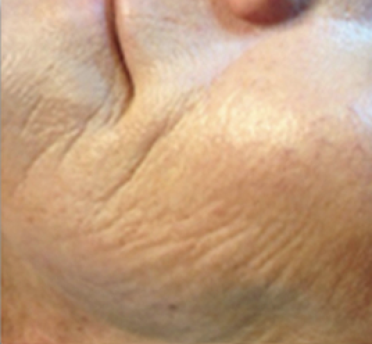 Micro-Needling Before